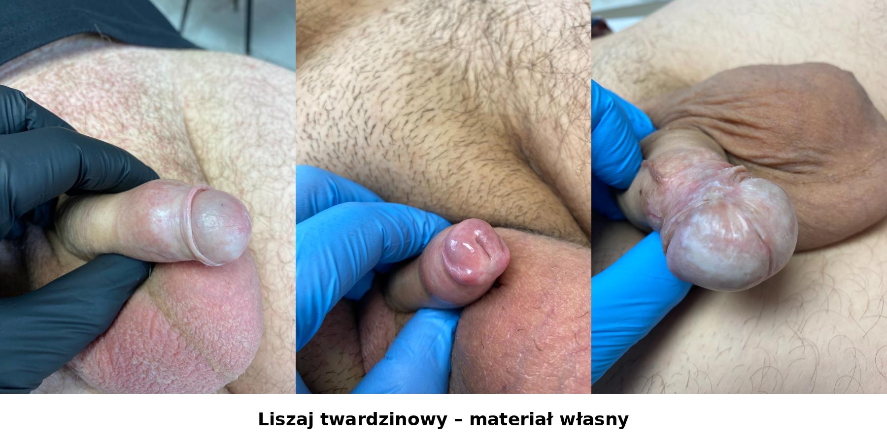 Liszaj twardzinowy - materiał własny